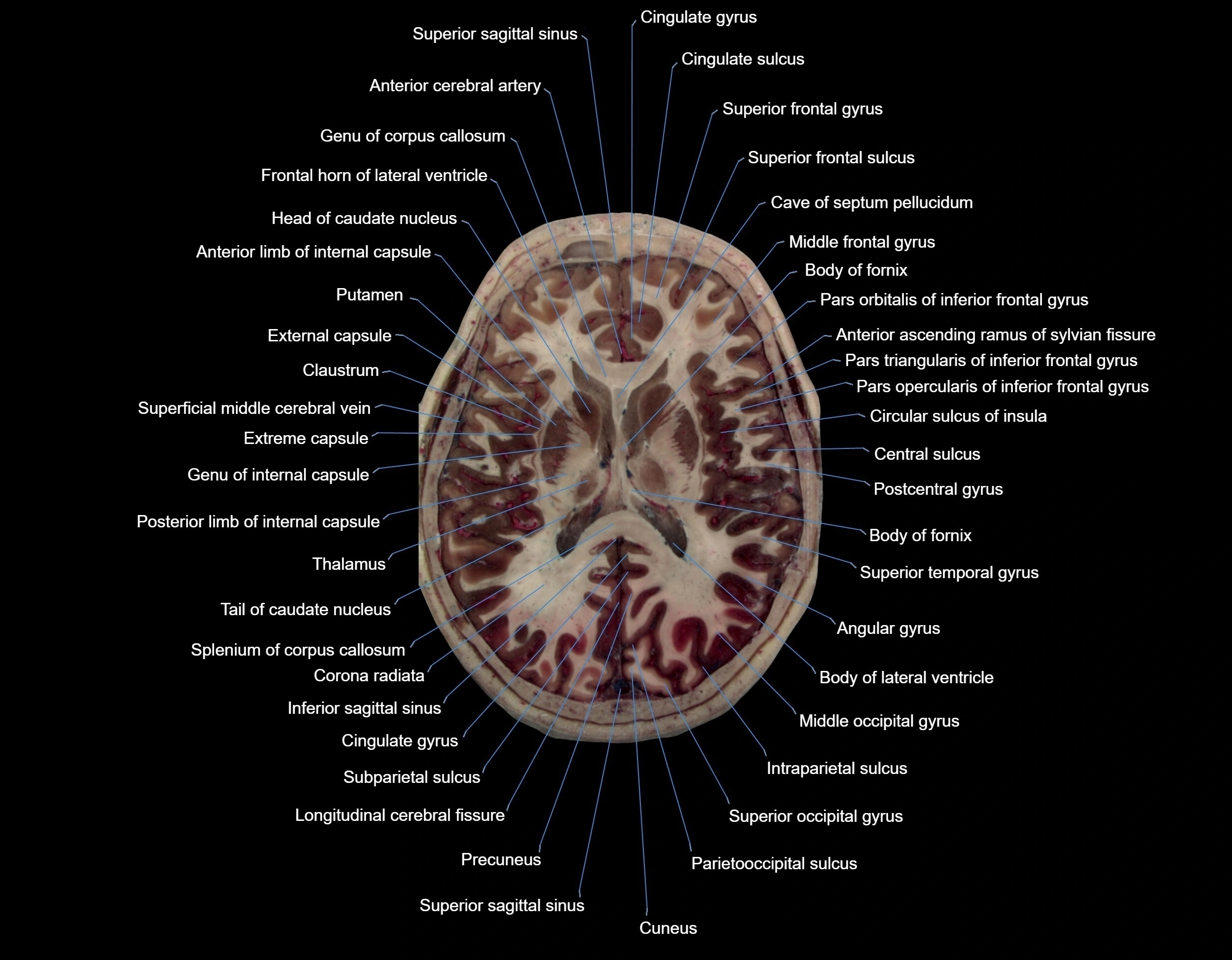 MRI Brain axial cross sectional radiology anatomy 3T image  -img-000047.webp
